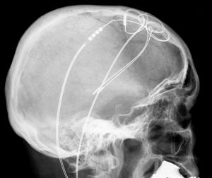 De chips die Bryan Johnson wil ontwikkelen gebruiken een principe dat ook bij Deep-Brain Stimulation wordt gebruikt. Beeld: Hellerhoff/Wikimedia Commons