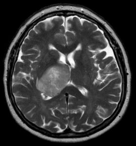 glioblastoma